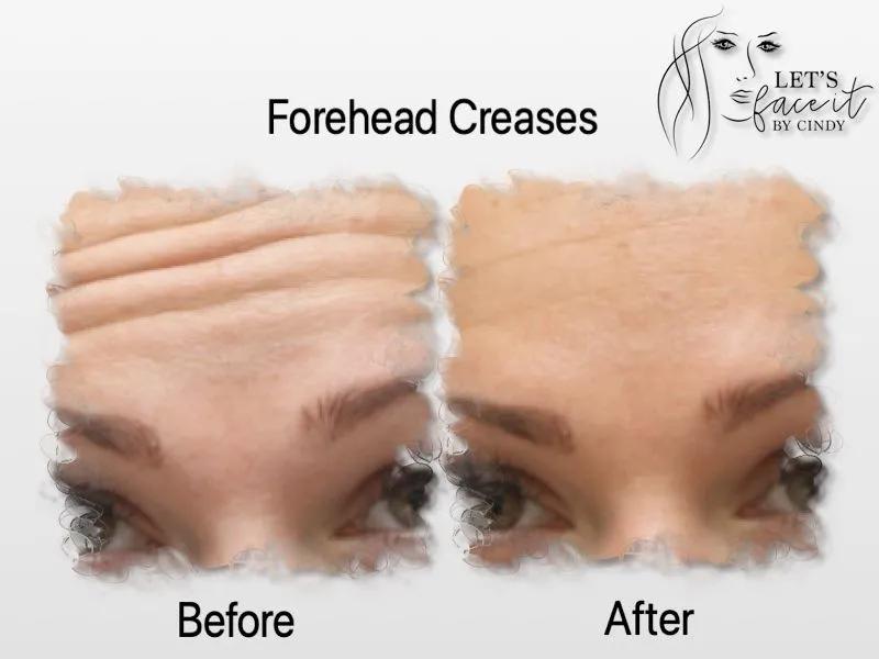 A before and after photo of a woman 's forehead creases.