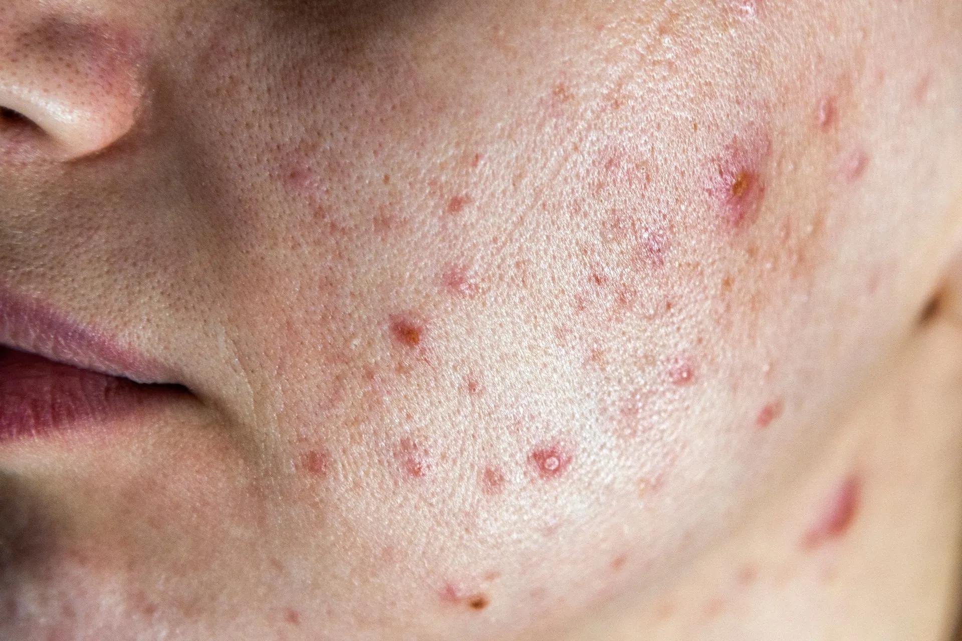A close up of a person 's face with acne on it.