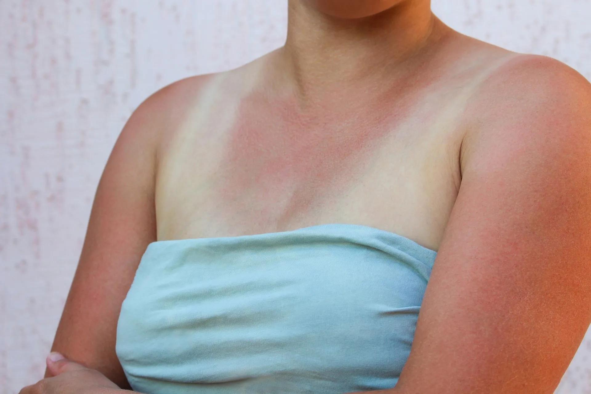 A woman with a sunburned chest and arms is wearing a strapless top.