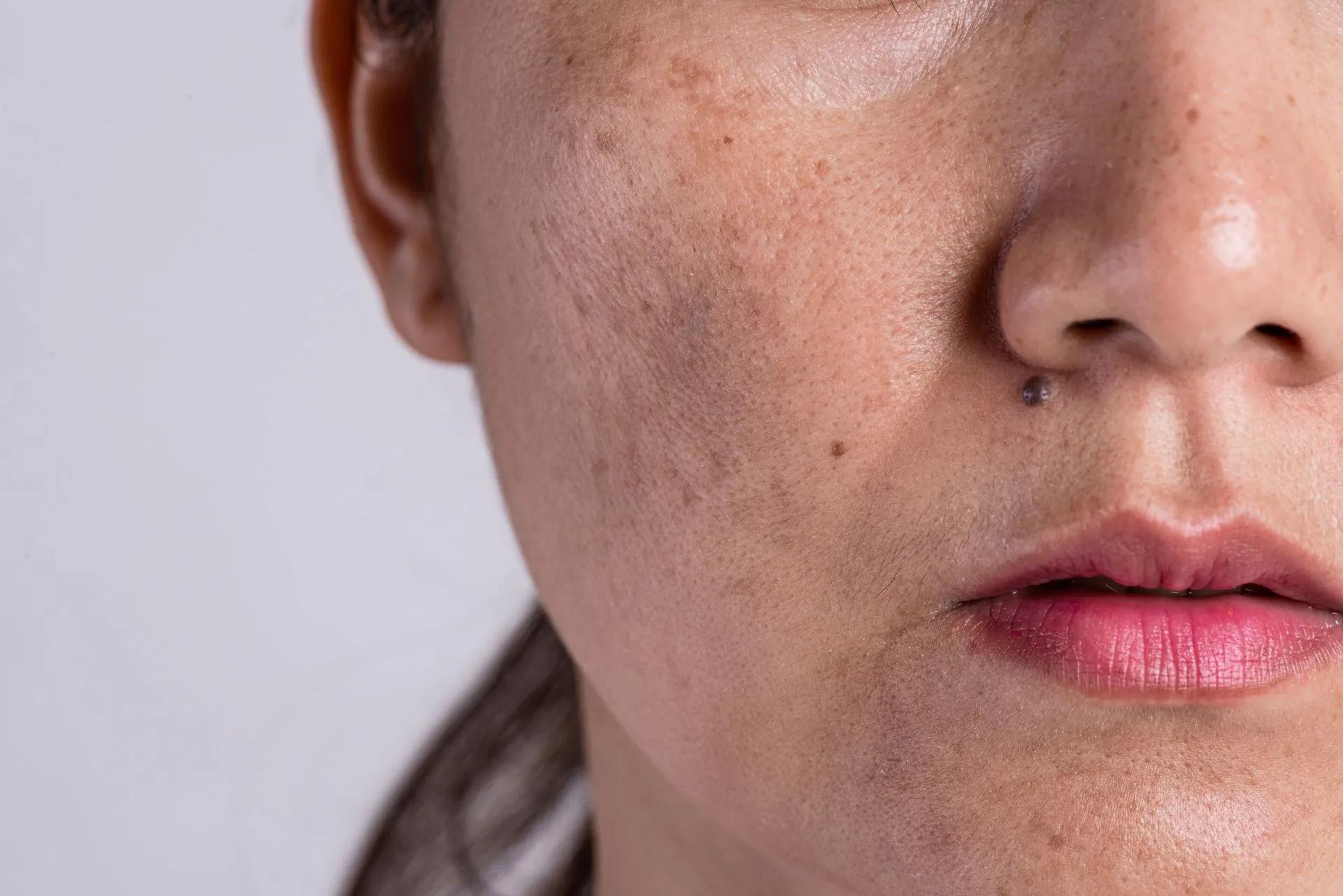 A close up of a woman 's face with spots on it.